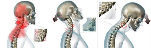 X-ray of Whiplash CAD