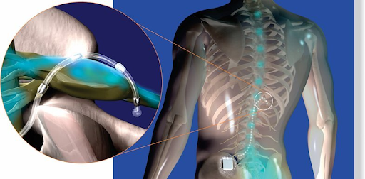 X-ray of Dorsal Root Ganglion Stimulator (DRG)