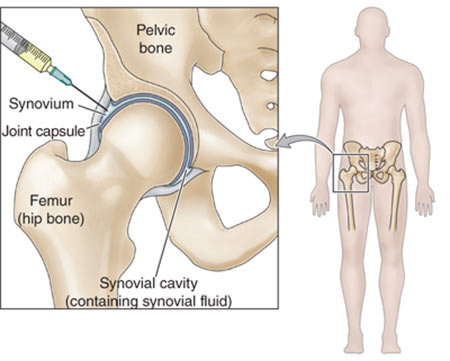 Hip Joint Injections