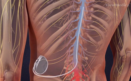 Intrathecal Pain Pumps