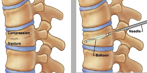 Kyphoplasty Procedure