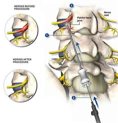 Lumbar Sympathetic Ganglion Block