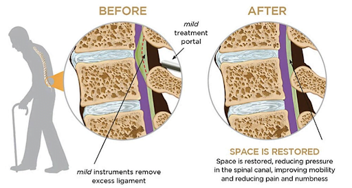 Minimally Invasive Lumbar Decompression (MILD) Procedure- Before and After