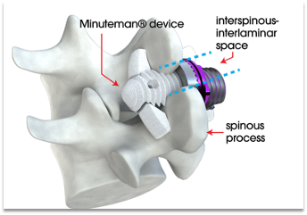 Minuteman Procedure