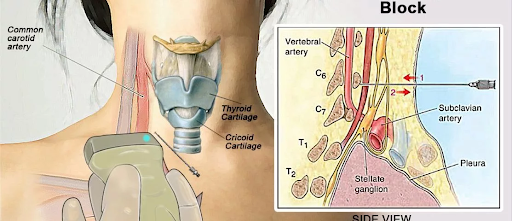 Stellate Ganglion Block