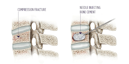 Vertebroplasty