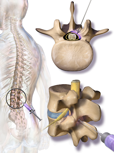 Lumbar Epidural Spinal Injection (LESI)