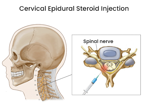 Cervical Epidural Steroid Injection