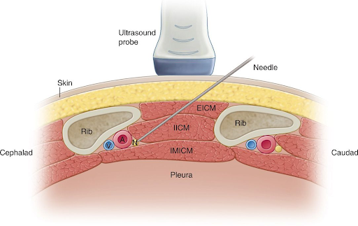 Intercostal Nerve Block