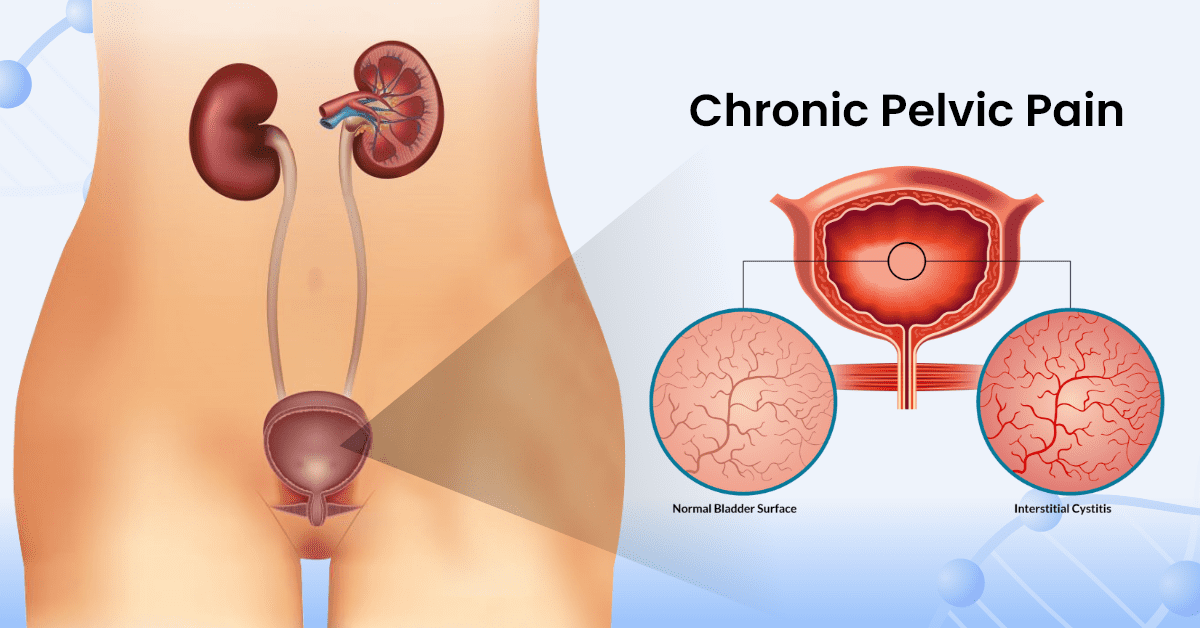 Chronic Pelvic Pain Treatment