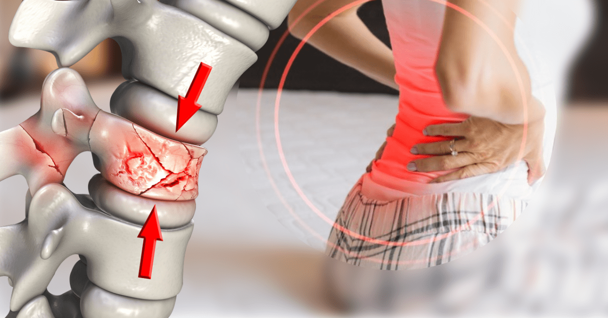 Compression Fractures Of The Spine