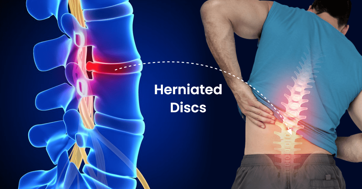 Herniated Discs