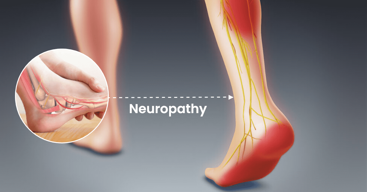 Neuropathy