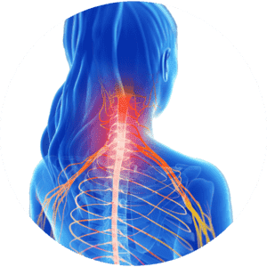 Cervical Radiculopathy