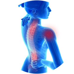 Complex Regional Pain Syndrome