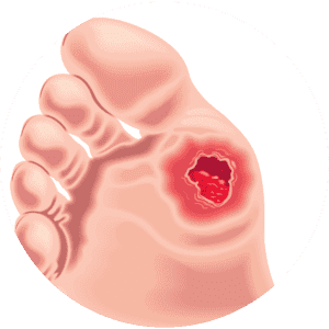 Diabetic Neuropathy