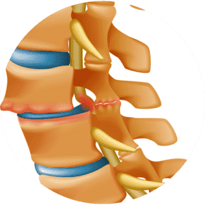 Herniated Discs