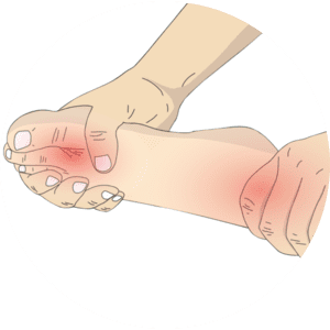 Neuropathy