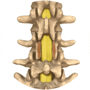 Post Laminectomy Syndrome