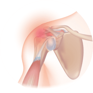 Shoulder Pain