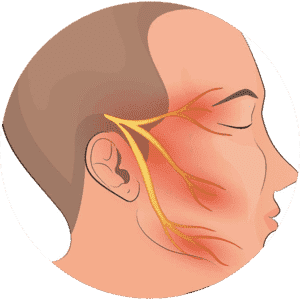 Trigeminal Neuralgia