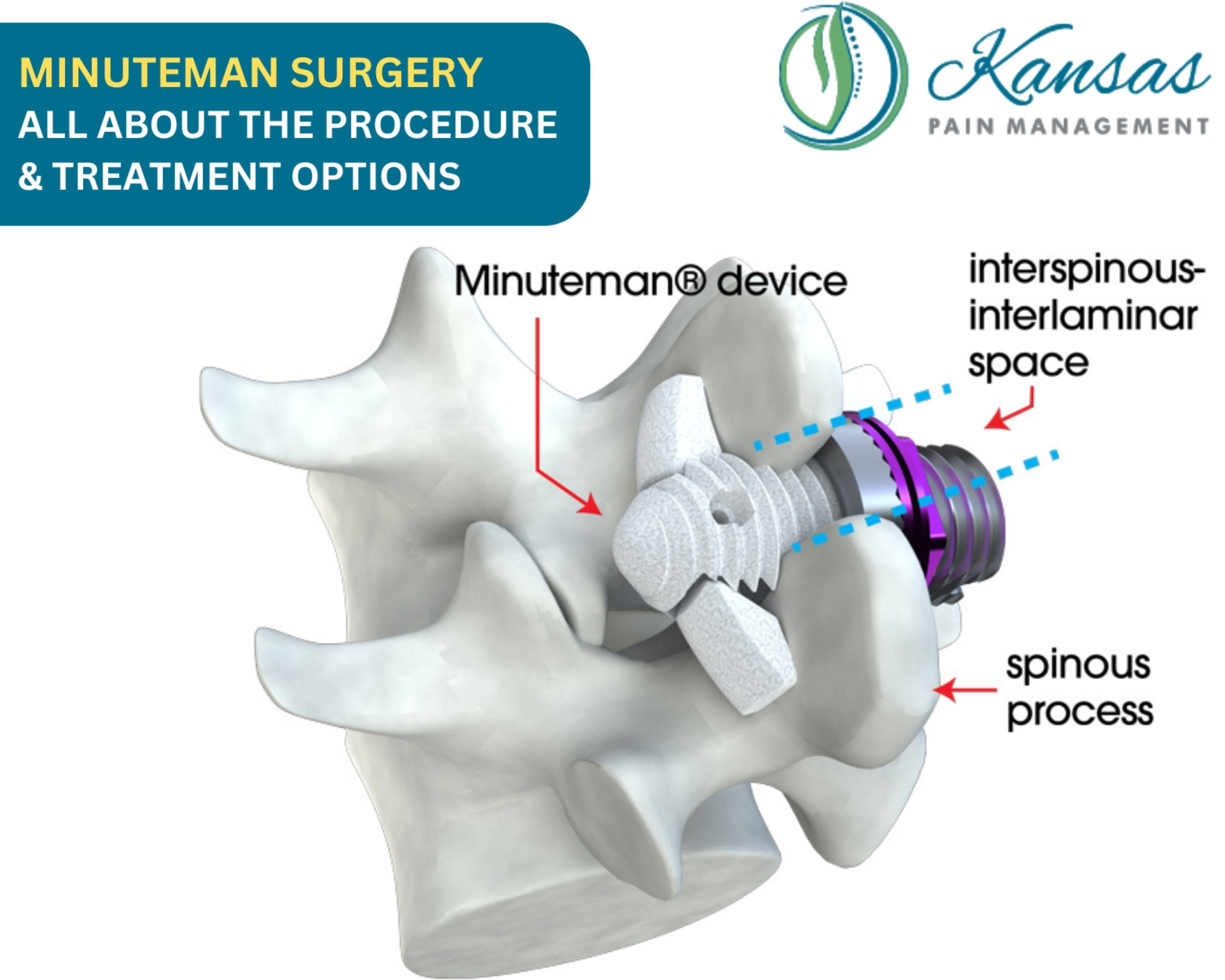 what-is-minuteman-surgery