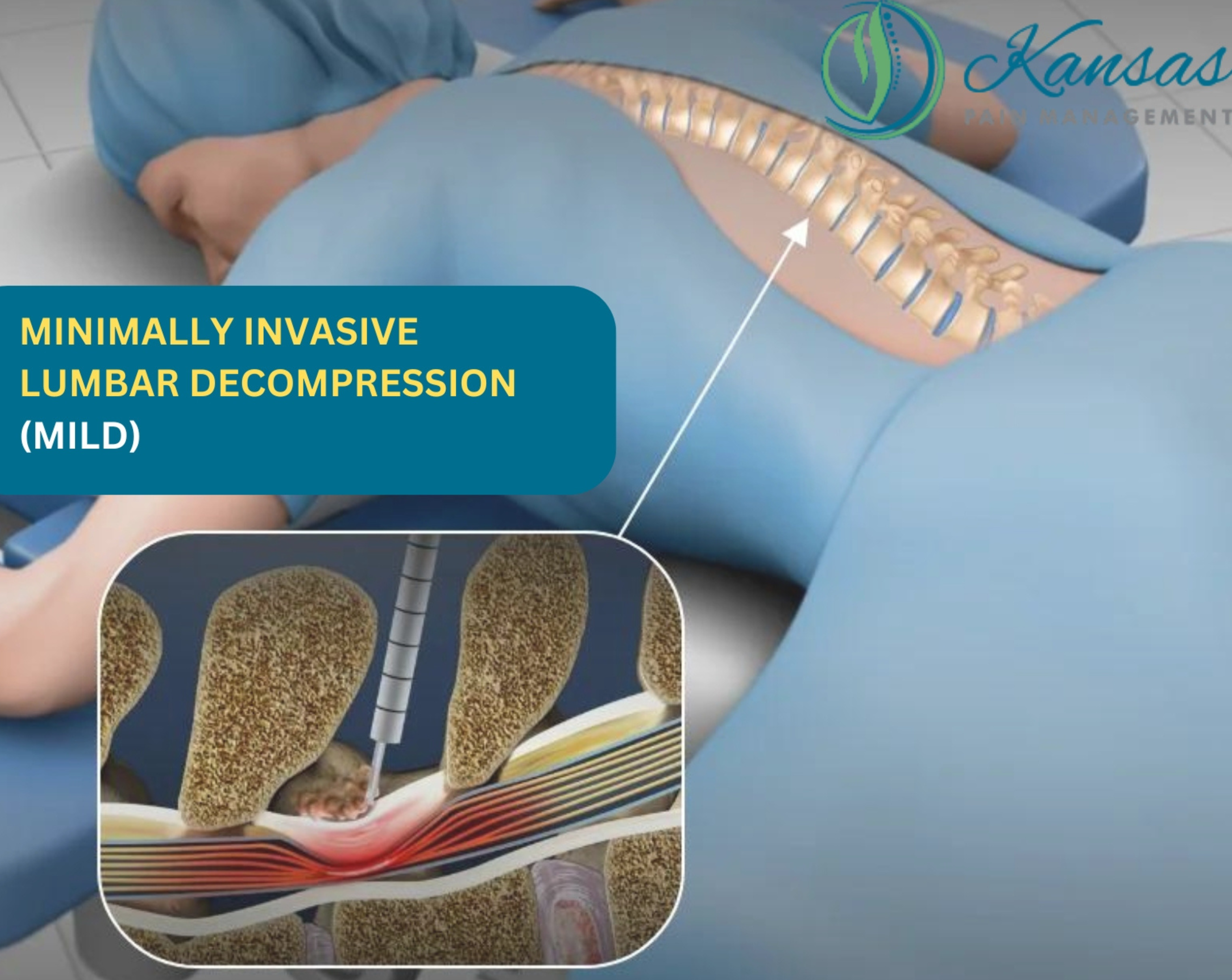 What Is Minimally Invasive Lumbar Decompression (MILD)